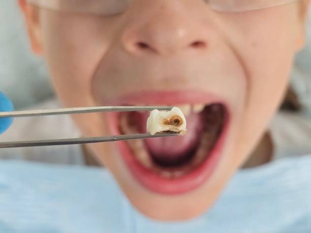 Best Knocked-Out Tooth Emergency  in Sylvester, GA